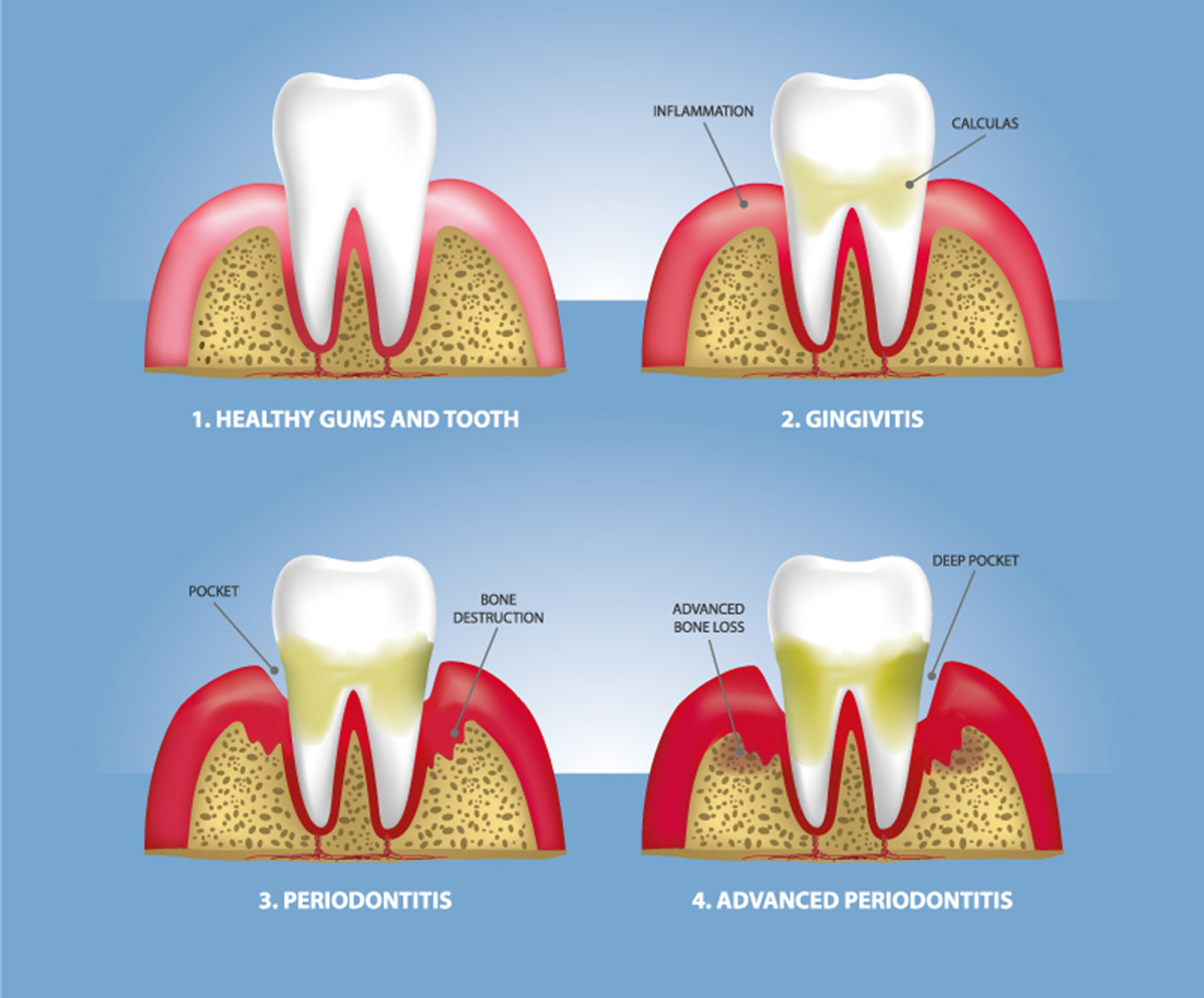 gum-disease-sounds-terrible-what-is-it-dental-at-keys