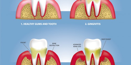 Are Red, Swollen, Or Sore, Bleeding Gums A Sign Of Gum Disease?