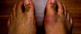 What Should You Know About Reactive Arthritis?