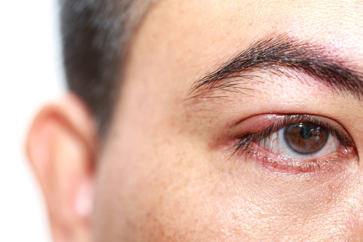 arthritis-and-eye-conditions-6-ways-arthritis-affects-the-eyes