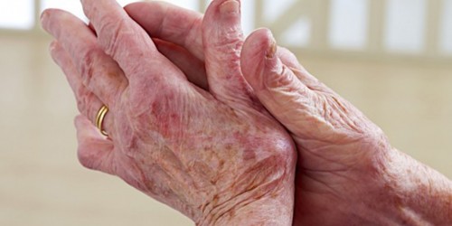 Controlling and Managing Arthritis