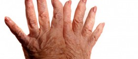 Connection between Carpal Tunnel Syndrome (CTS) & Arthritis