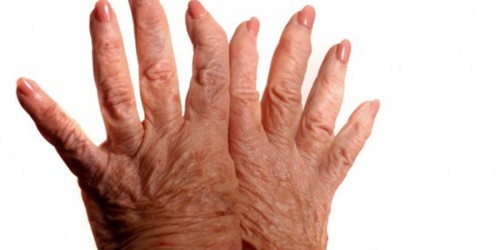 Connection between Carpal Tunnel Syndrome (CTS) & Arthritis
