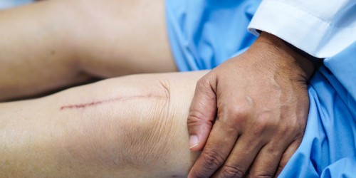 Arthritis Treatment: 4 Things You Should Know About Different Types Of Knee Replacement Surgery