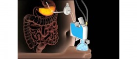 Aspireassist: Medically Induced Bulimia For Quick Weight Loss