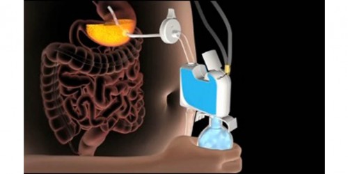 Aspireassist: Medically Induced Bulimia For Quick Weight Loss