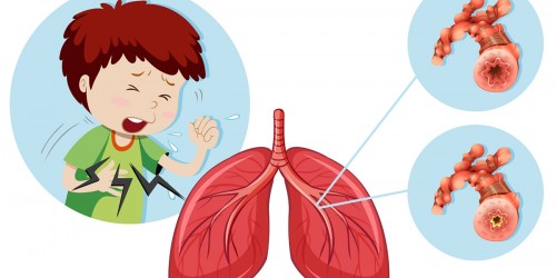 What Is Asthma?