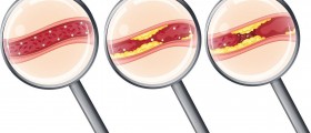Atherosclerosis As A Major Cause Of Coronary Artery Disease: 7 Things You Should Know