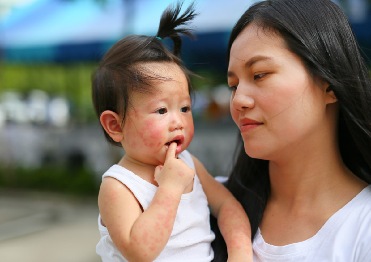Atopic Dermatitis And Babies Should You Treat Eczema In Infants With