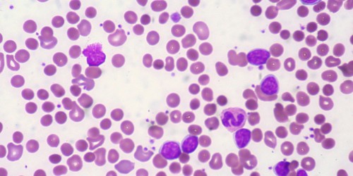 Common Autoimmune Disorders And How To Deal With Them