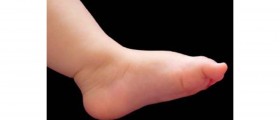 Flat Feet in Children
