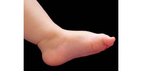 Flat Feet in Children
