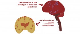 Brain-Eating Amoeba Due To Stagnant Water, CDC Says