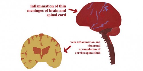 Brain-Eating Amoeba Due To Stagnant Water, CDC Says