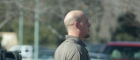Hair Transplants For Men In Their 20s - What Do The Experts Say?