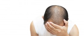 What you should know about baldness