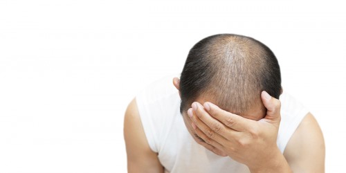 What you should know about baldness
