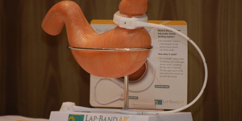 Bariatric Surgery Should Not Be The Last Resort