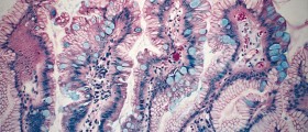 Barrett's Esophagus: What Is It?