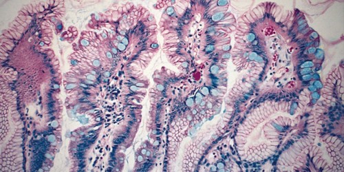 Barrett's Esophagus: What Is It?