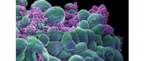 Is Breast Cancer Tied To Breast Size?
