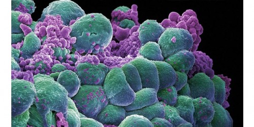 Is Breast Cancer Tied To Breast Size?