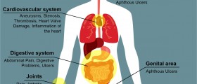 Behcet's Syndrome