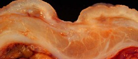 Peptic Ulcer Disease: Everything You Need To Know About Symptoms And Treatment