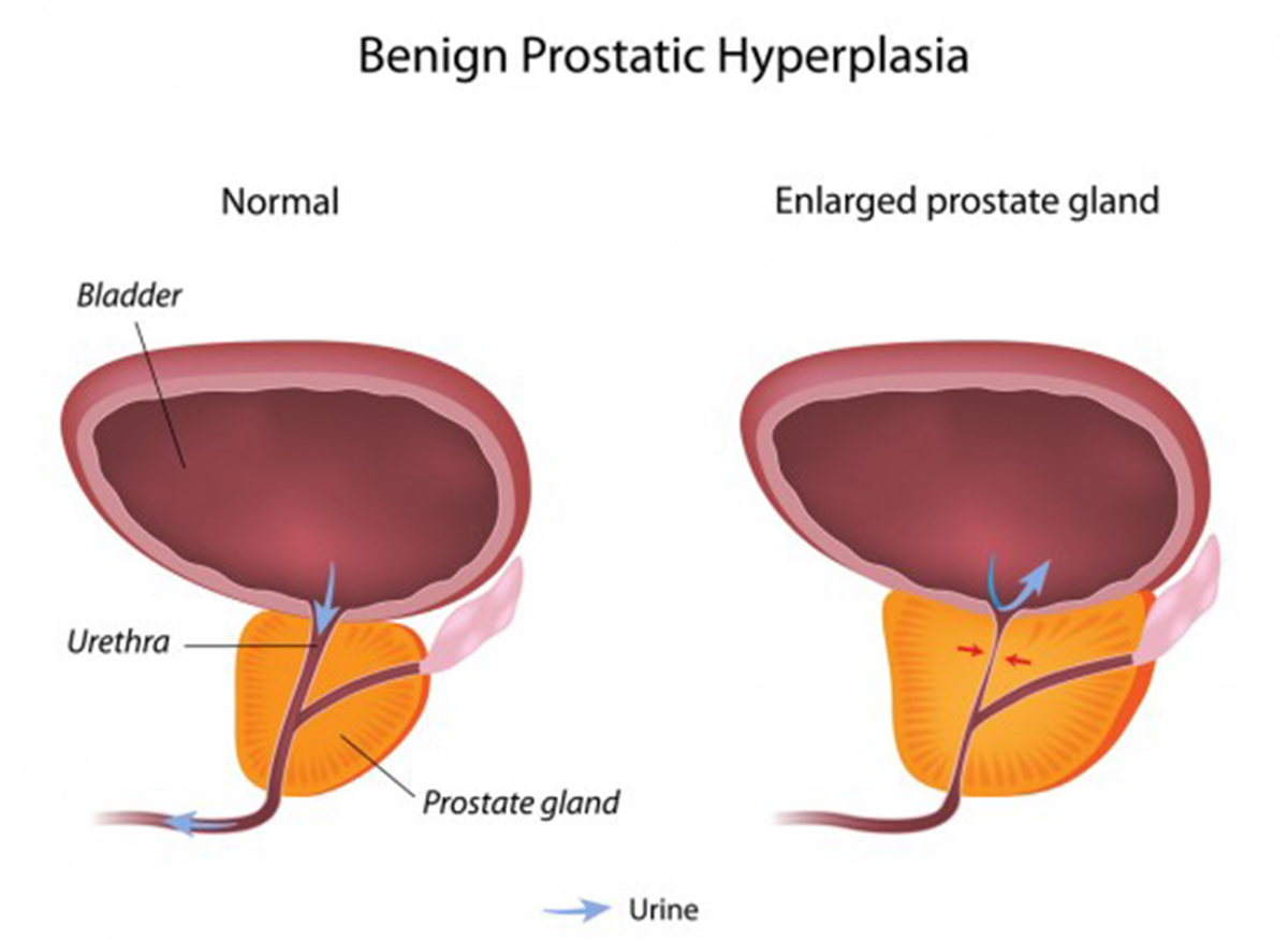 The Eventuality of Benign Prostatic Hyperplasia | Men's Health articles ...