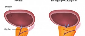 The Eventuality of Benign Prostatic Hyperplasia