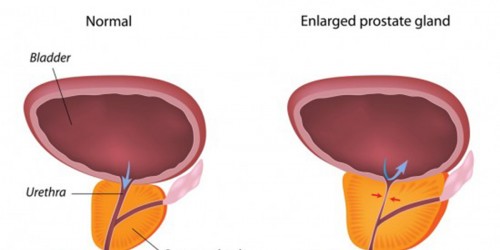 The Eventuality of Benign Prostatic Hyperplasia