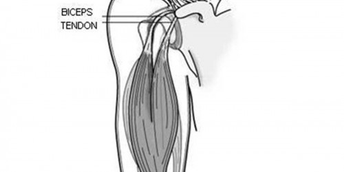 Biceps Tendinitis