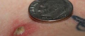 Black Salve: The Alternative Cancer Treatment That Can Make Half Your Face Fall Off