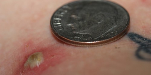 Black Salve: The Alternative Cancer Treatment That Can Make Half Your Face Fall Off