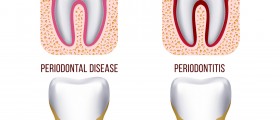 Bleeding Gums - Causes, Symptoms, Treatment