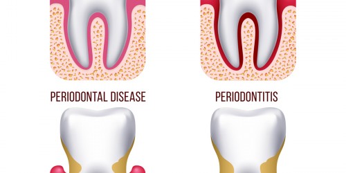 Bleeding Gums - Causes, Symptoms, Treatment