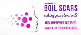 Boil Scars Making Your Blood Boil? How To Prevent And Treat Scars Left Over From Boils