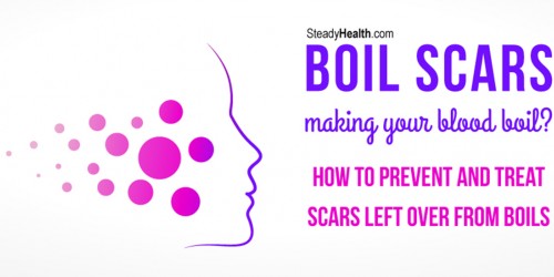 Boil Scars Making Your Blood Boil? How To Prevent And Treat Scars Left Over From Boils