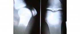 Ewing's Sarcoma Symptoms and Treatment