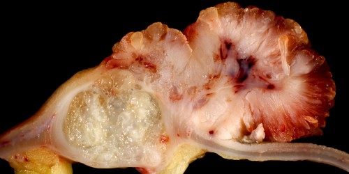 Colorectal Surgery: What To Expect From Your Bowel Cancer Operation