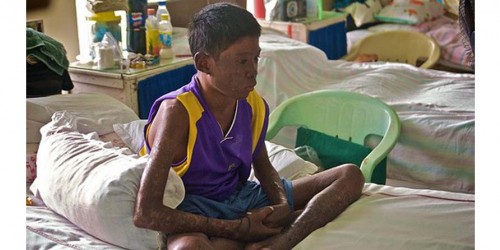 Leprosy - Unfinished Story