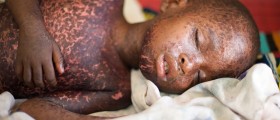 Measles, Mumps And Rubella: What Are They Really Like?