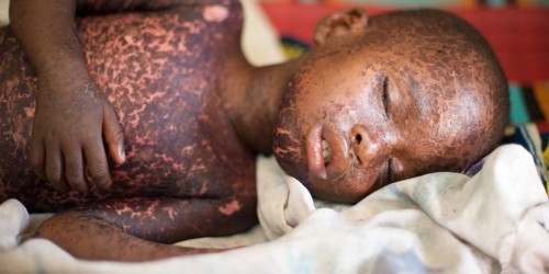 Measles, Mumps And Rubella: What Are They Really Like?