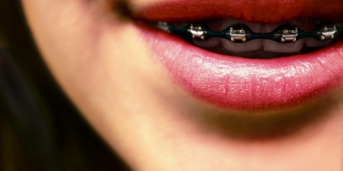 What Is Interventional Orthodontics? Is Its Use Warranted Or is It Overrated?