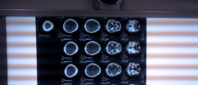Fahr's Syndrome Or Brain Stones, A Rare Neurological Disease
