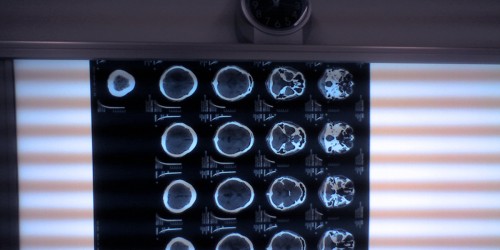Fahr's Syndrome Or Brain Stones, A Rare Neurological Disease