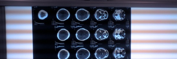 Fahr's Syndrome Or Brain Stones, A Rare Neurological Disease