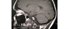 Neurofibromatosis Genetic Disorder: Nerve Tissue, Skin and Bones Abnormalities