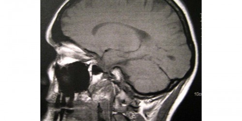 Neurofibromatosis Genetic Disorder: Nerve Tissue, Skin and Bones Abnormalities