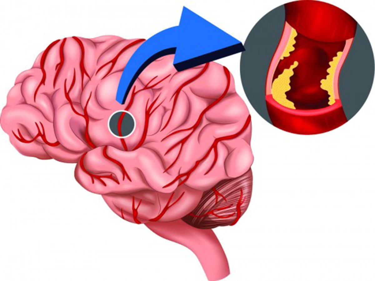 Reducing Incidence Of Stroke With Thrombolytics